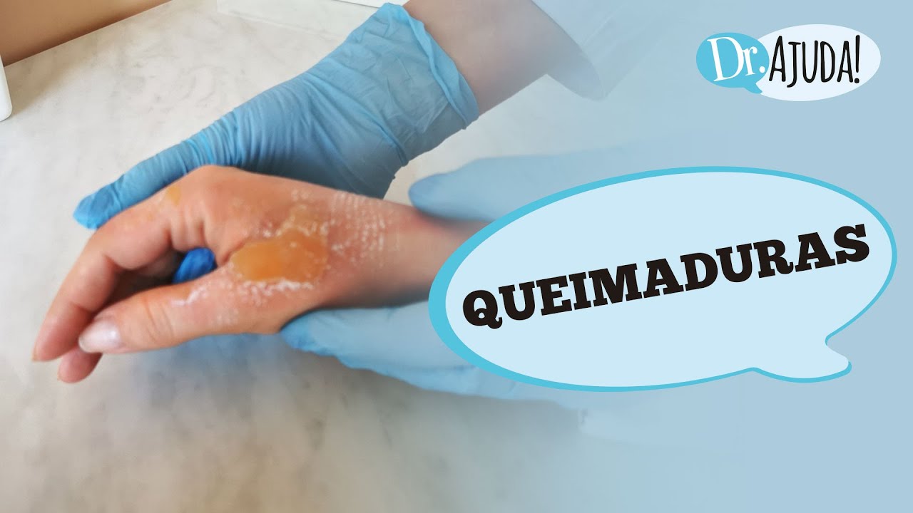 Queimaduras: como avaliar o grau, tratar e evitar?