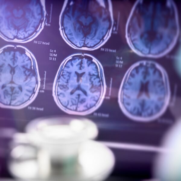 Diagnóstico precoce do Alzheimer ajuda pacientes e famílias a viverem&hellip;