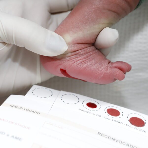 DF é pioneiro no diagnóstico precoce da doença de Fabry&hellip;