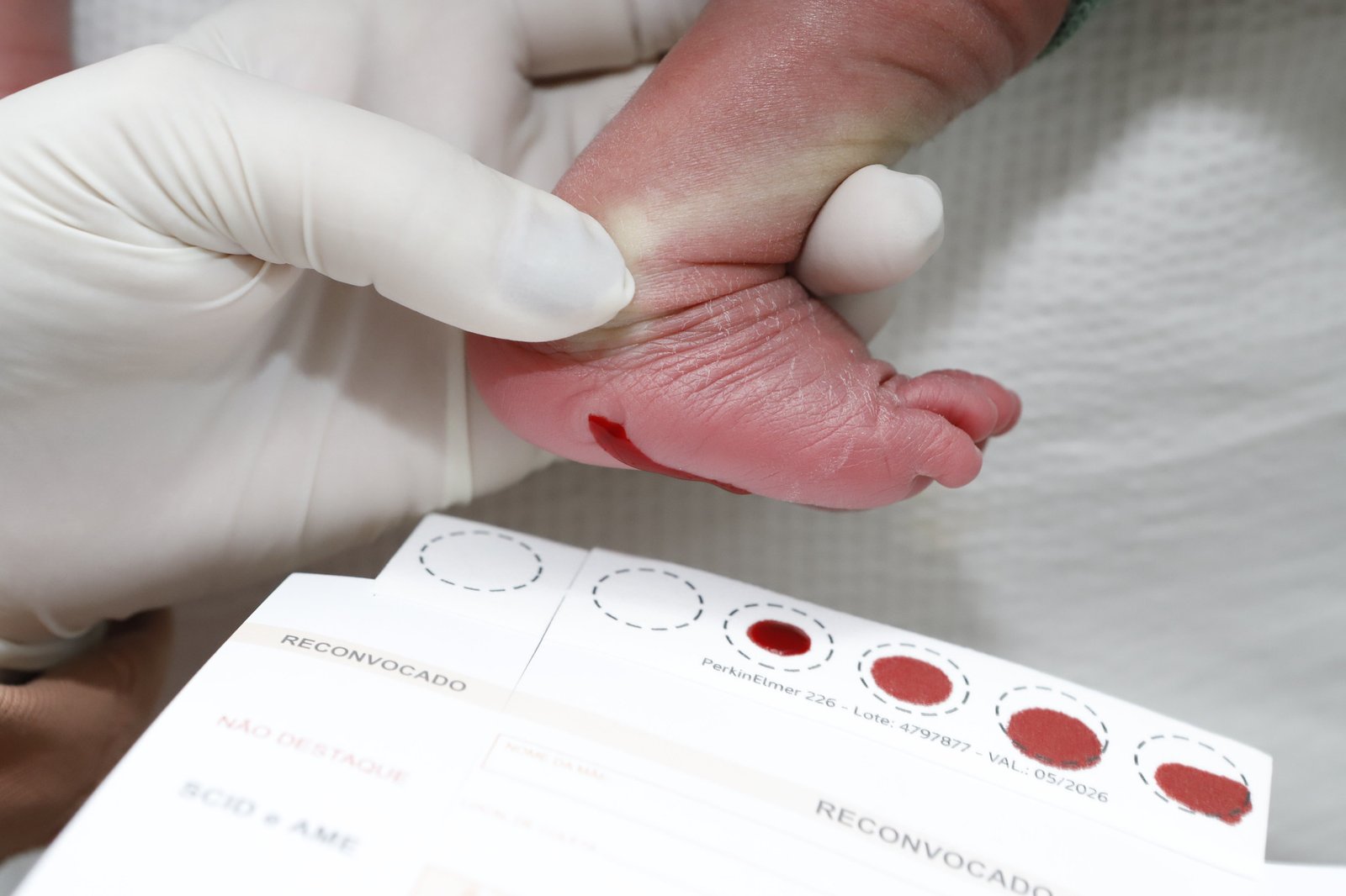 DF é pioneiro no diagnóstico precoce da doença de Fabry pelo teste do pezinho